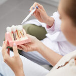 dental implants, dental implants model, dentist in euless