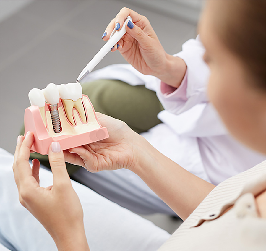 dental implants, dental implants model, dentist in euless