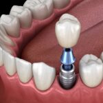 dental implants, dental crowns, Family Dentistry of Bedford, dental treatment options, oral health, Bedford TX dentist, dental care, tooth replacement options