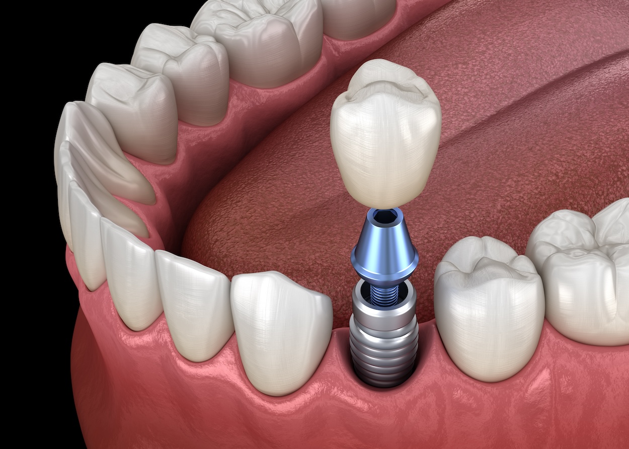 dental implants, dental crowns, Family Dentistry of Bedford, dental treatment options, oral health, Bedford TX dentist, dental care, tooth replacement options