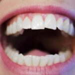 asymmetrical smile, cosmetic dentistry, dental veneers, orthodontics, gum contouring, teeth whitening, dental bonding, Family Dentistry of Bedford