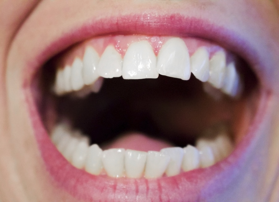 asymmetrical smile, cosmetic dentistry, dental veneers, orthodontics, gum contouring, teeth whitening, dental bonding, Family Dentistry of Bedford