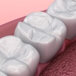 tooth colored fillings
