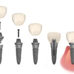 parts of a dental implant, dental implants or dentures