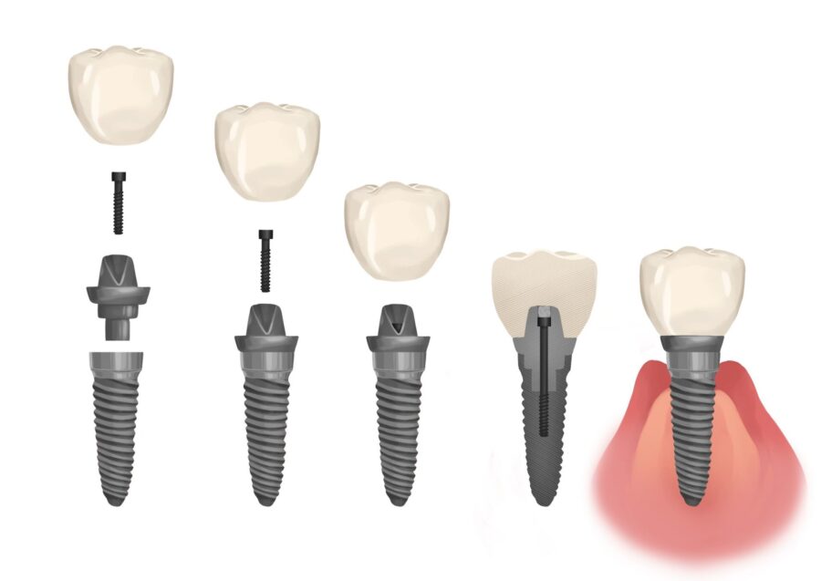 parts of a dental implant, dental implants or dentures