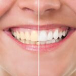 teeth whitening or porcelain veneers to improve your smile