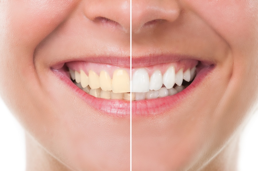 teeth whitening or porcelain veneers to improve your smile